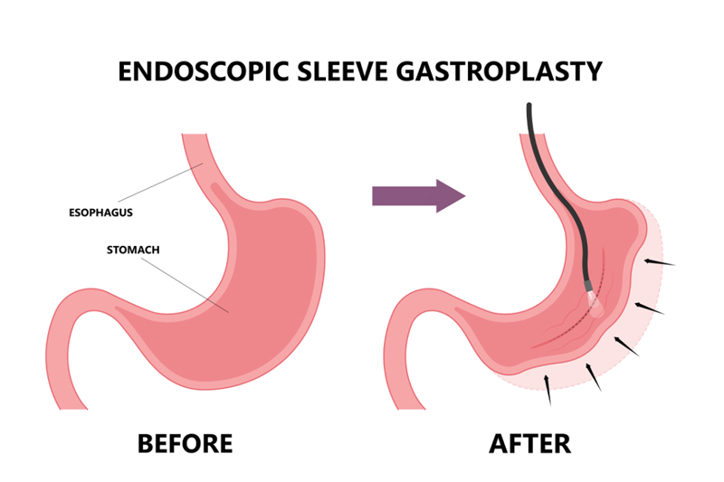 Endoscopic sleeve gastroplasty in Delhi NCR and Gurgaon test in Gurgaon & Dehli NCR