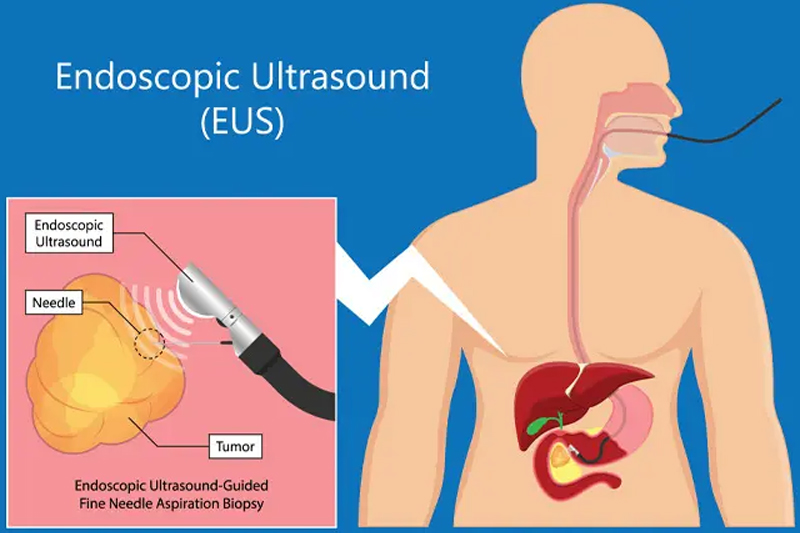 Endoscopic Ultrasound (EUS) test in Gurgaon & Dehli NCR